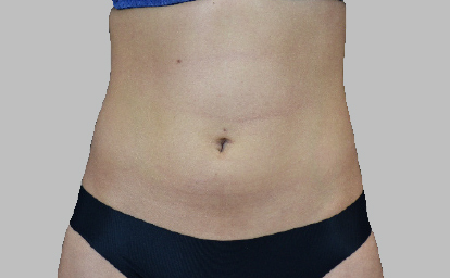 embody-abs2-antes