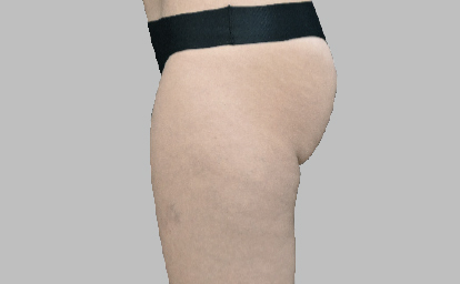 embody-bumbum-antes