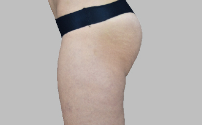 embody-bumbum-depois