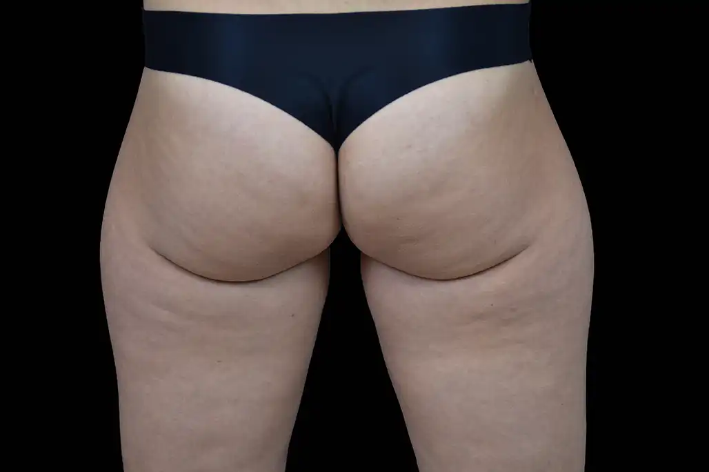 embody-bumbum2-antes