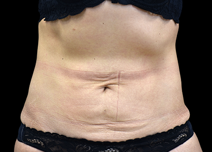 emtone-barriga-antes