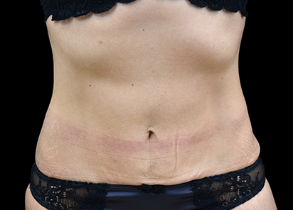 emtone-barriga-depois