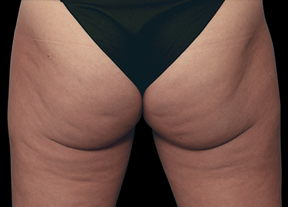 emtone-bumbum-antes