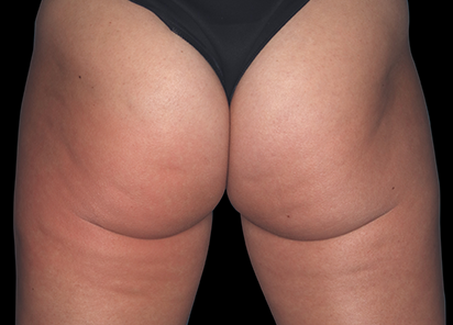 emtone-bumbum-depois