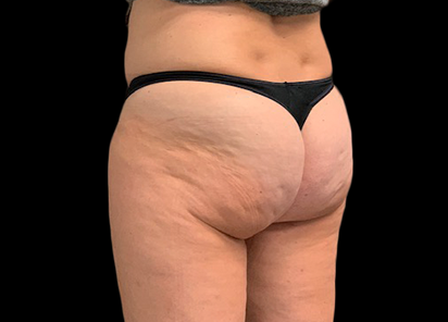 emtone-bumbum2-antes