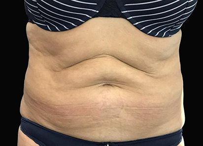exilis-barriga-antes