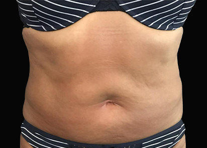 exilis-barriga-depois