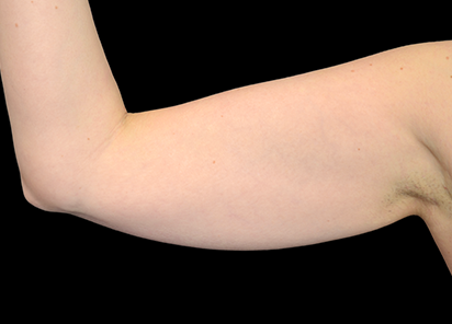 exilis-braco-antes