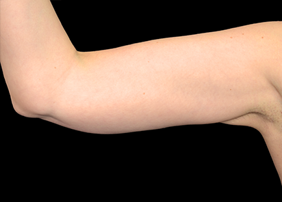 exilis-braco-depois