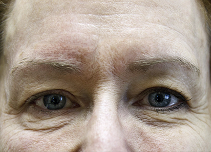exilis-olhos-antes