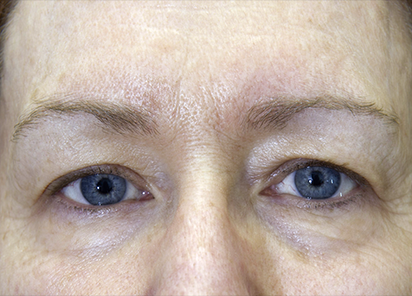 exilis-olhos-depois