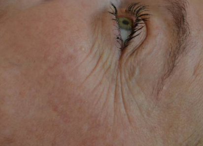 exilis-olhos2-antes