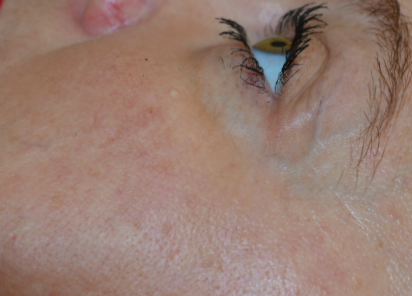 exilis-olhos2-depois