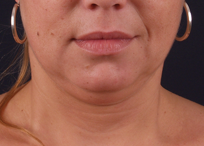 exilis-papada-antes