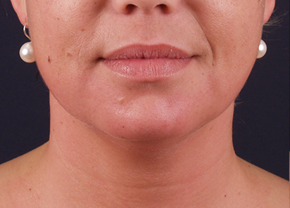 exilis-papada-depois