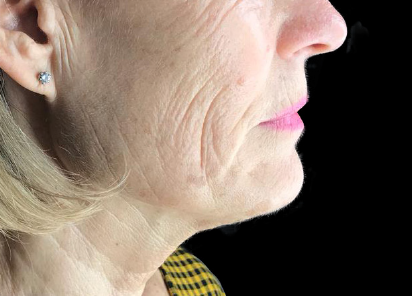 exilis-rosto-antes