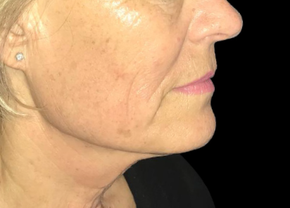 exilis-rosto-depois