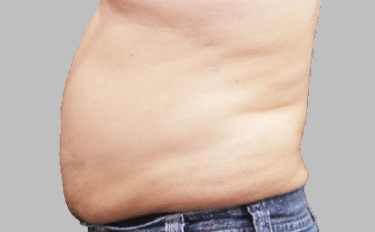 vanquish-abdomen-antes