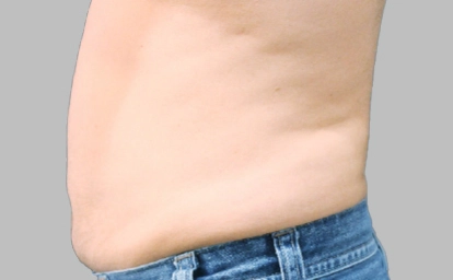 vanquish-abdomen-depois