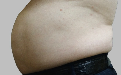 vanquish-abdomen2-antes