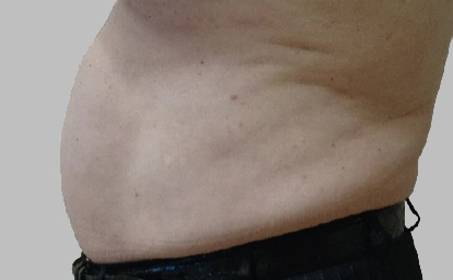 vanquish-abdomen2-depois