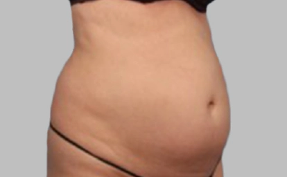 vanquish-abdomen3-antes