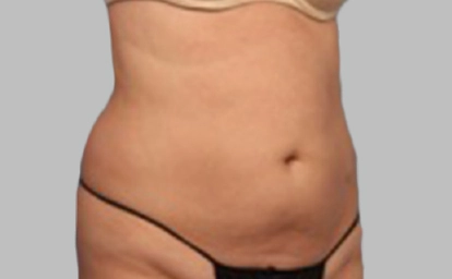 vanquish-abdomen3-depois