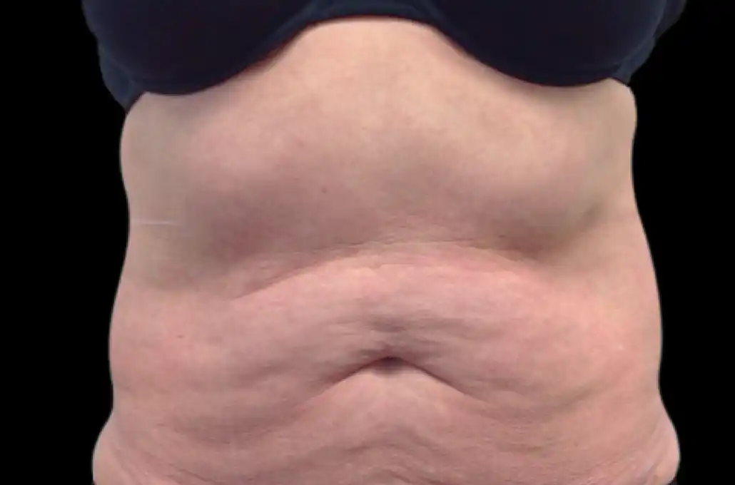 xwave-abdomen-antes