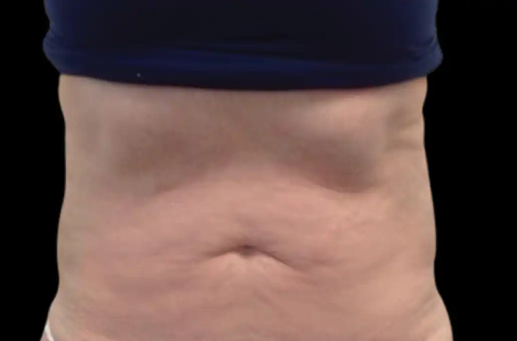 xwave-abdomen-depois
