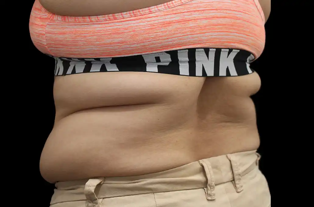 xwave-abdomen2-antes