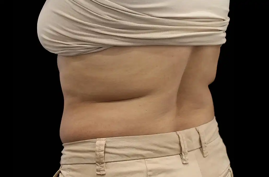 xwave-abdomen2-depois