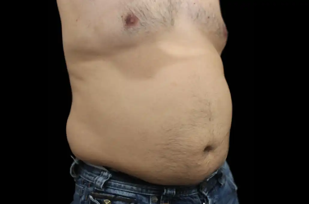 xwave-abdomen3-antes