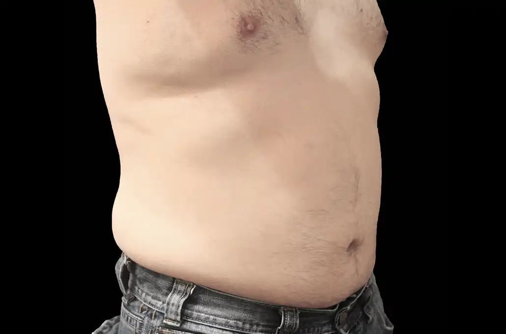 xwave-abdomen3-depois